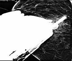 Breast Stereotactic